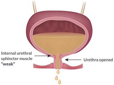 What is Bulkamid Injection  Bulkamid for Stress Incontinence