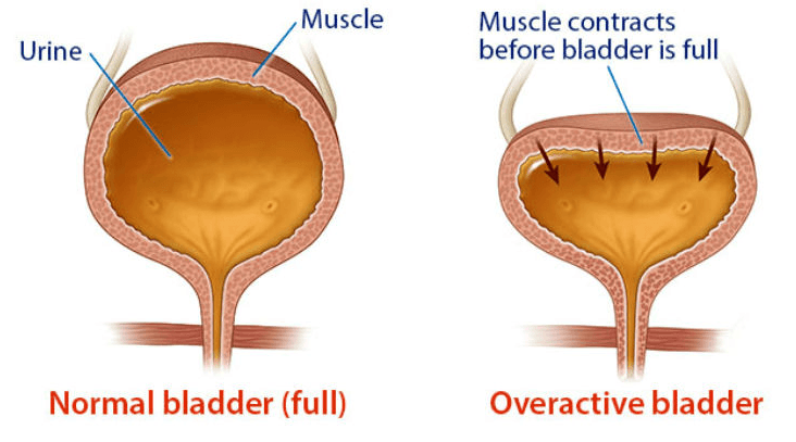 Normal bladder vs overactive bladder