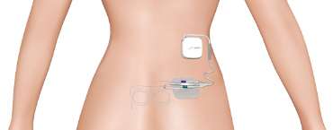 Axonics® System Basic Trial